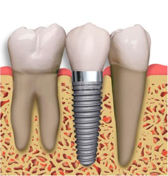 Implantologia Oral